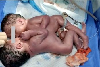 Nacen siamesas en el hospital Uyapar