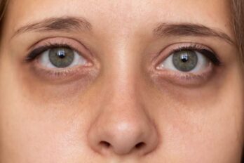 Ojeras