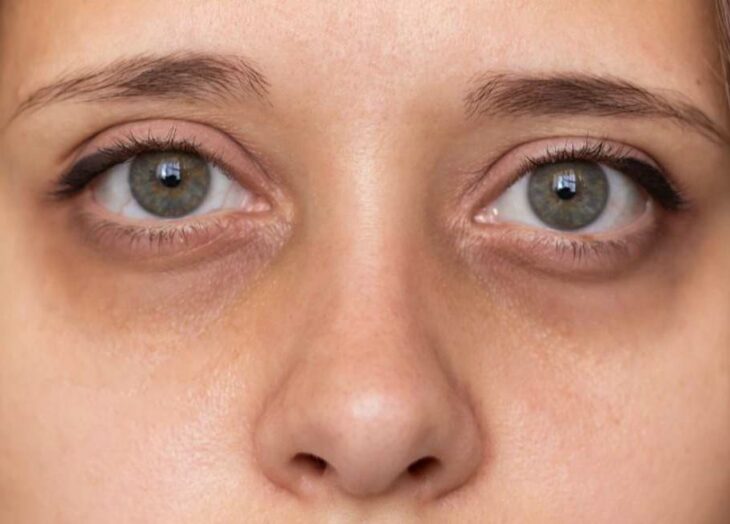 Ojeras