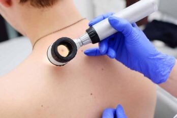 melanoma