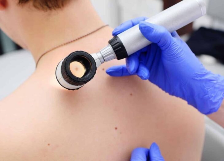 melanoma