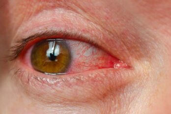 conjuntivitis