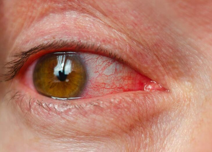 conjuntivitis