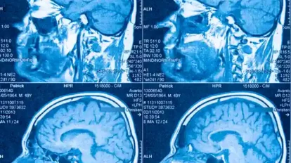 Identifican dos subtipos diferentes de autismo en el cerebro