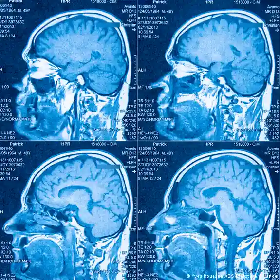 Identifican dos subtipos diferentes de autismo en el cerebro