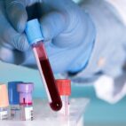 Desarrollan test para detectar cáncer de páncreas con muestra de sangre