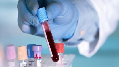 Desarrollan test para detectar cáncer de páncreas con muestra de sangre