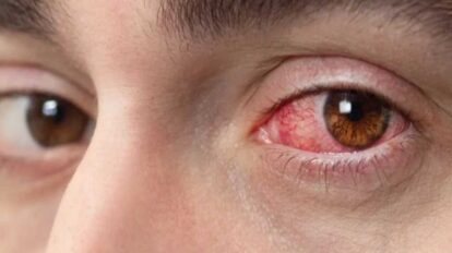 Alertan sobre incremento de alergias oculares en Aragua