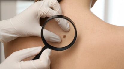 Cuba desarrolla tratamiento para el cáncer de piel