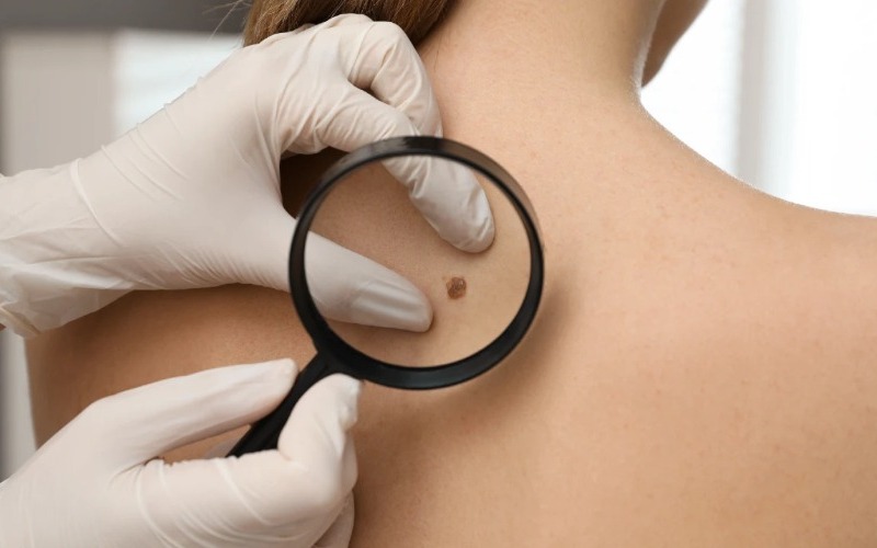 Cuba desarrolla tratamiento para el cáncer de piel