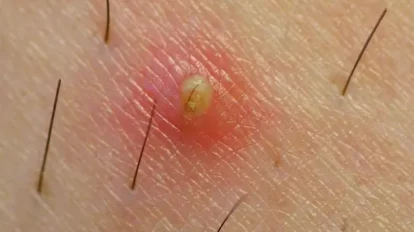 5 soluciones naturales para quitar los vellos encarnados
