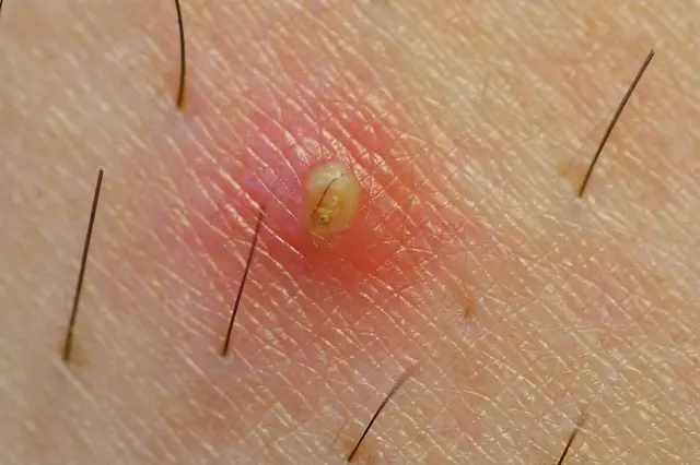 5 soluciones naturales para quitar los vellos encarnados