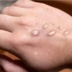 Atención sanitaria y vigilancia epidemiológica ante los casos de mpox reportados en San Petersburgo, Rusia.