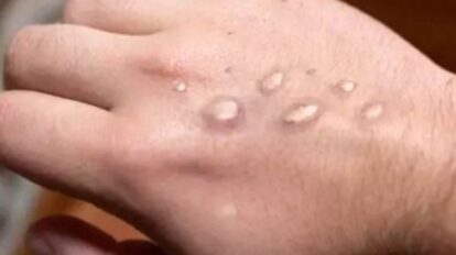 Atención sanitaria y vigilancia epidemiológica ante los casos de mpox reportados en San Petersburgo, Rusia.