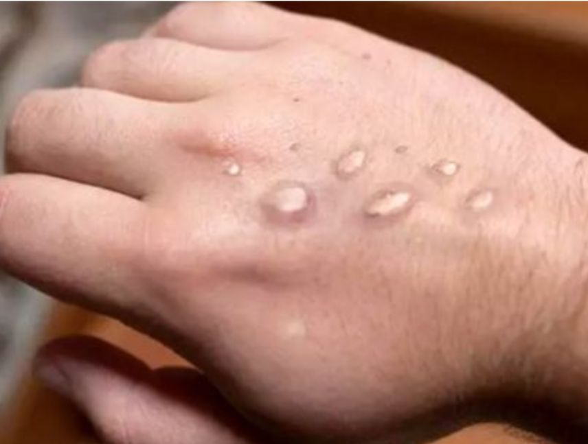 Atención sanitaria y vigilancia epidemiológica ante los casos de mpox reportados en San Petersburgo, Rusia.