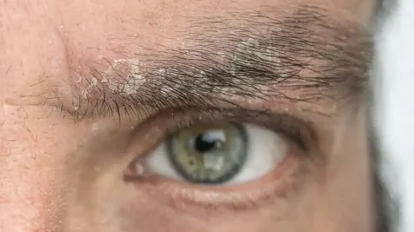 cómo eliminar caspa de las cejas
