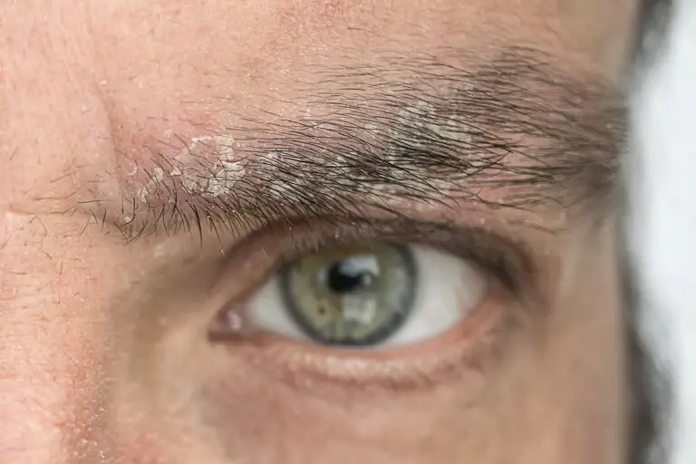 cómo eliminar caspa de las cejas