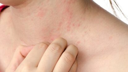 Remedios caseros para tratar la dermatitis de contacto