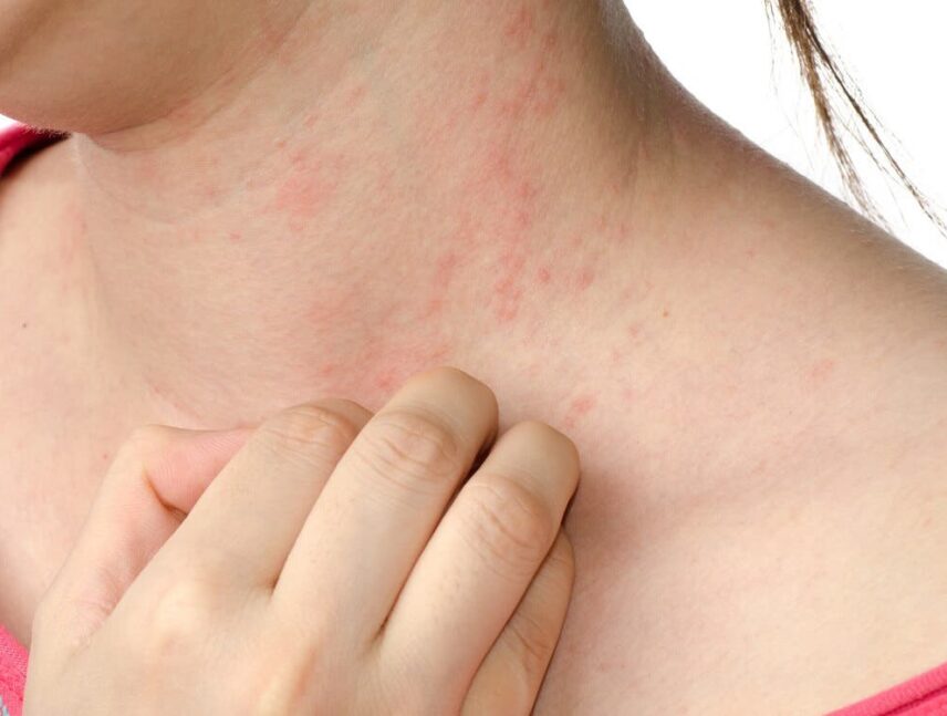 Remedios caseros para tratar la dermatitis de contacto